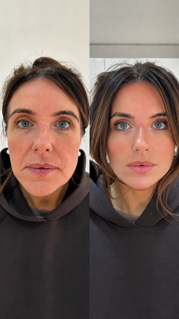 After a few months the biggest difference was my face. It looks less puffy more defined and I actually look alive again
